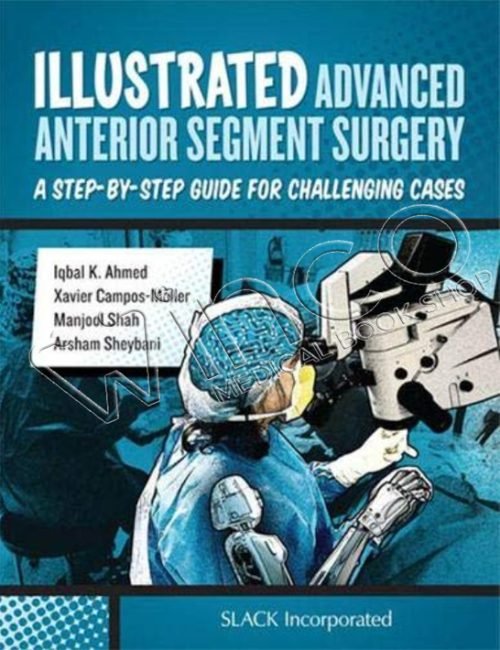 Illustrated Advanced Anterior Segment Surgery: A Step-by-Step Guide for Challenging Cases