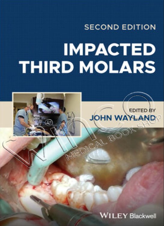 Impacted Third Molars, 2nd Edition